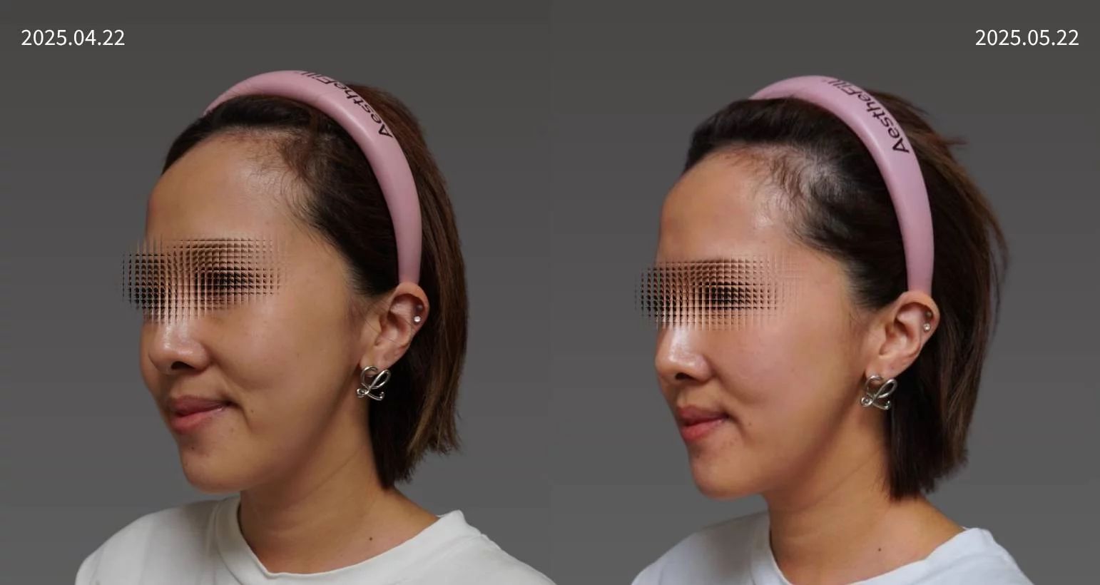 20250422朱培滋主播   皮秒雷射奇肌肉毒20U抬頭皺眉熊貓針 2