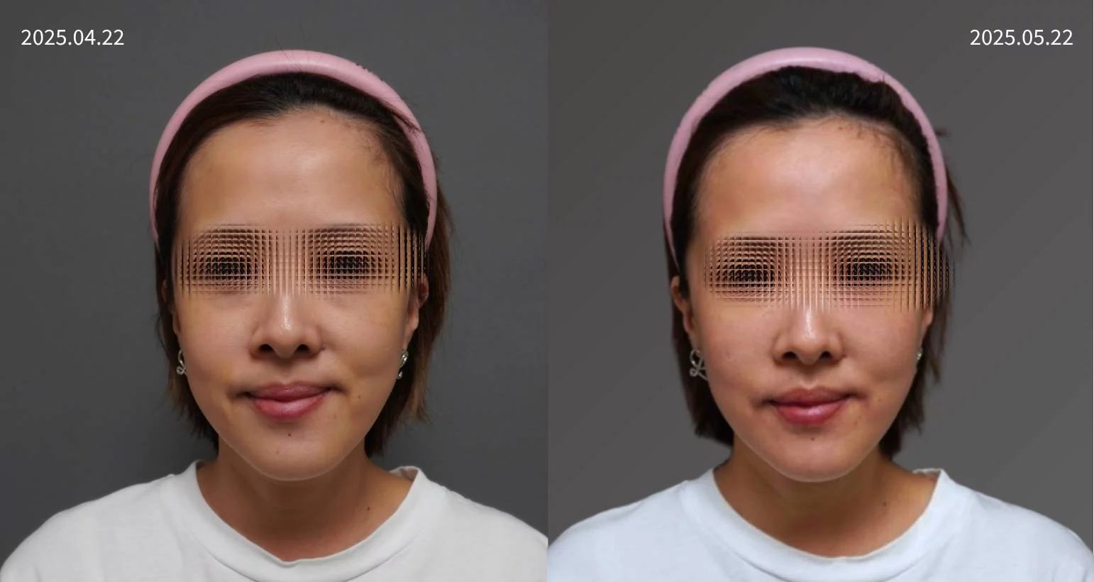 20250422朱培滋主播   皮秒雷射奇肌肉毒20U抬頭皺眉熊貓針 3