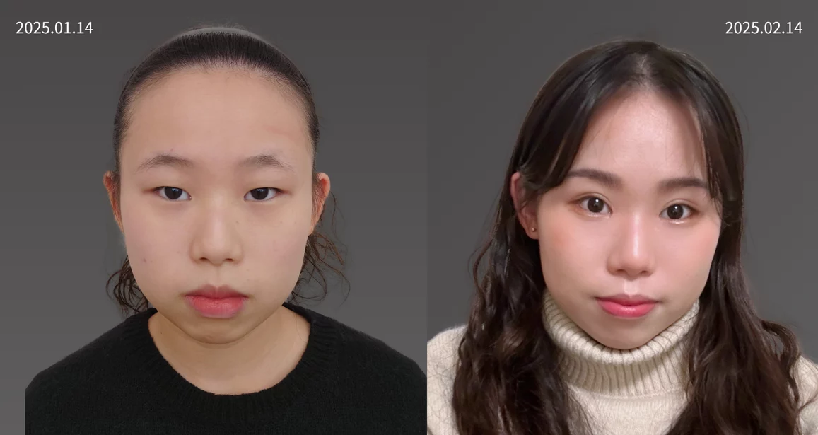 202502家嫺   雙眼皮