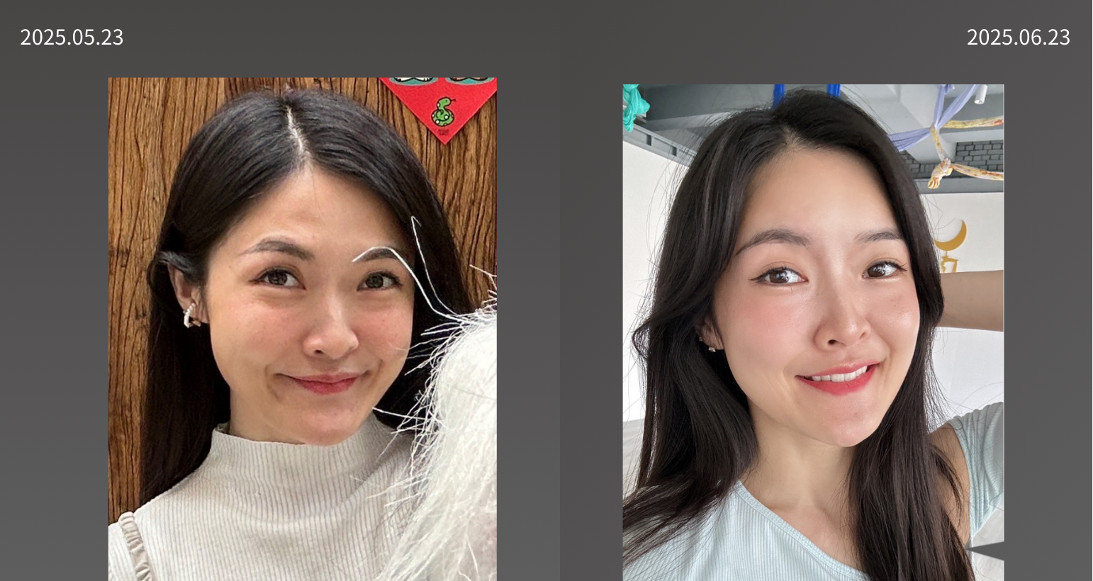 20250523鄭琬瑜   洢蓮絲額頭NEW