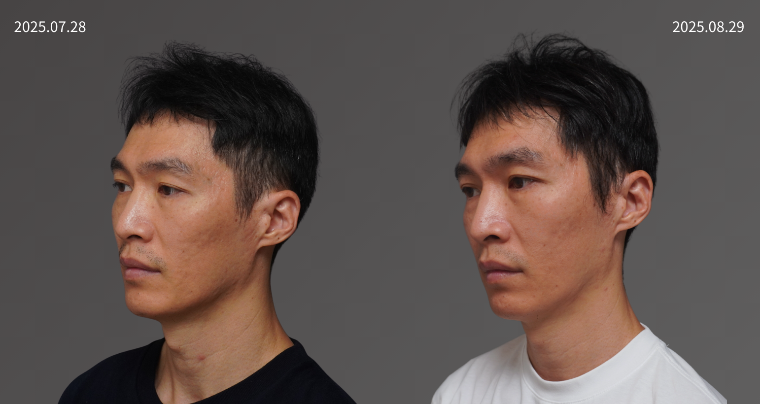 2025728周凰裕   精靈水光針2