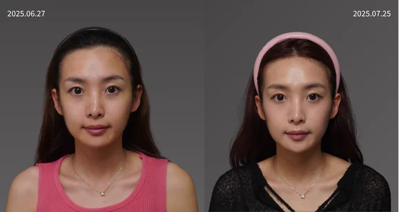 20250308黃巧梅 雙子音波 10 1