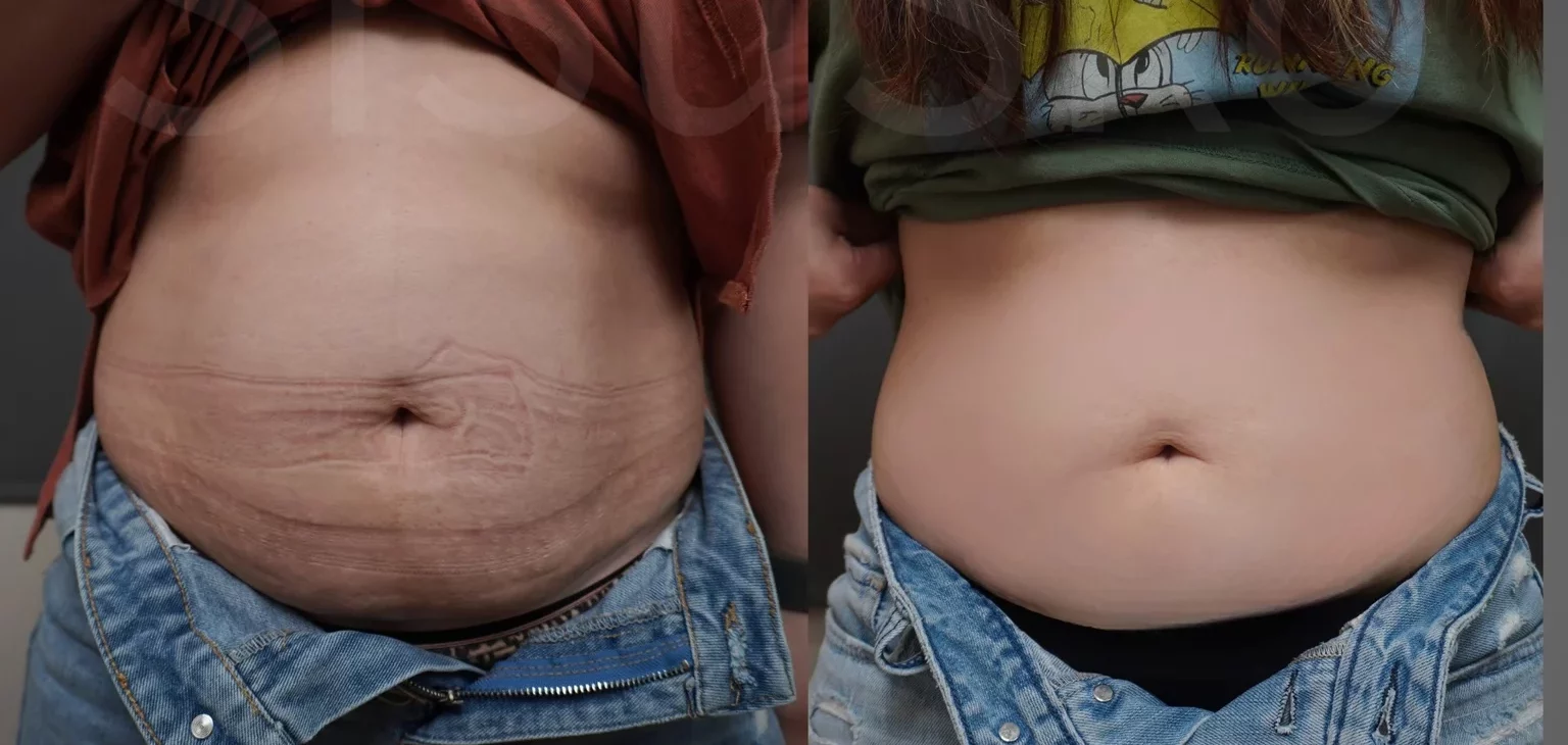 LINE ALBUM 微整案例 251112 1 1