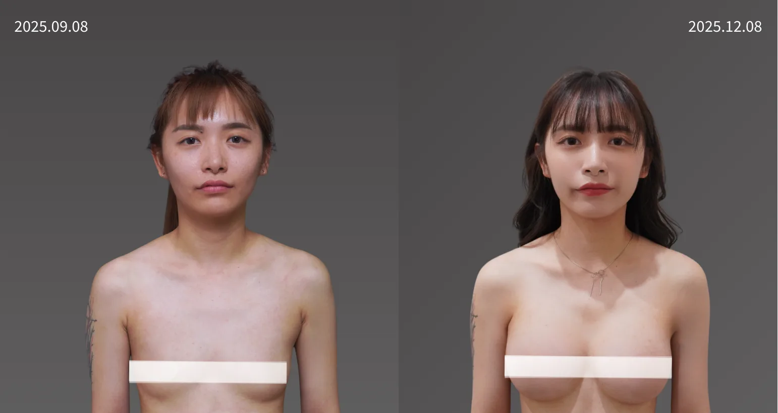 20251208曾雨涵 珍珠波隆乳4